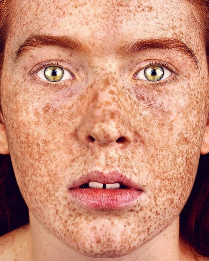 The Beauty of Freckles by Brock Elbank | Art Ctrl Del